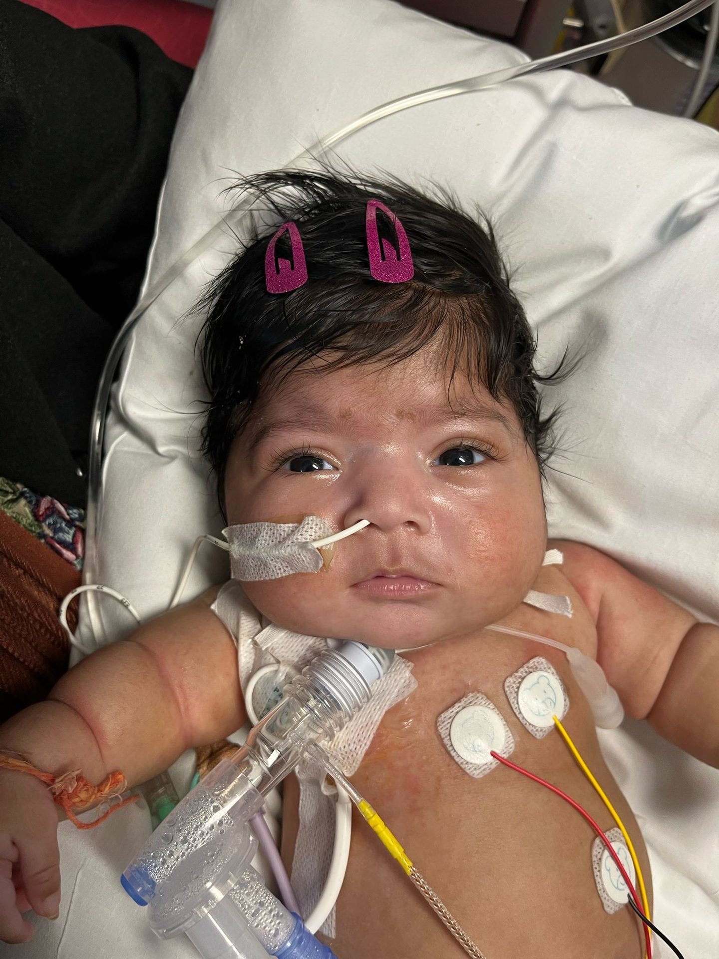 Infant with medical tubes, sensors, and pink hair clips in dark hair.