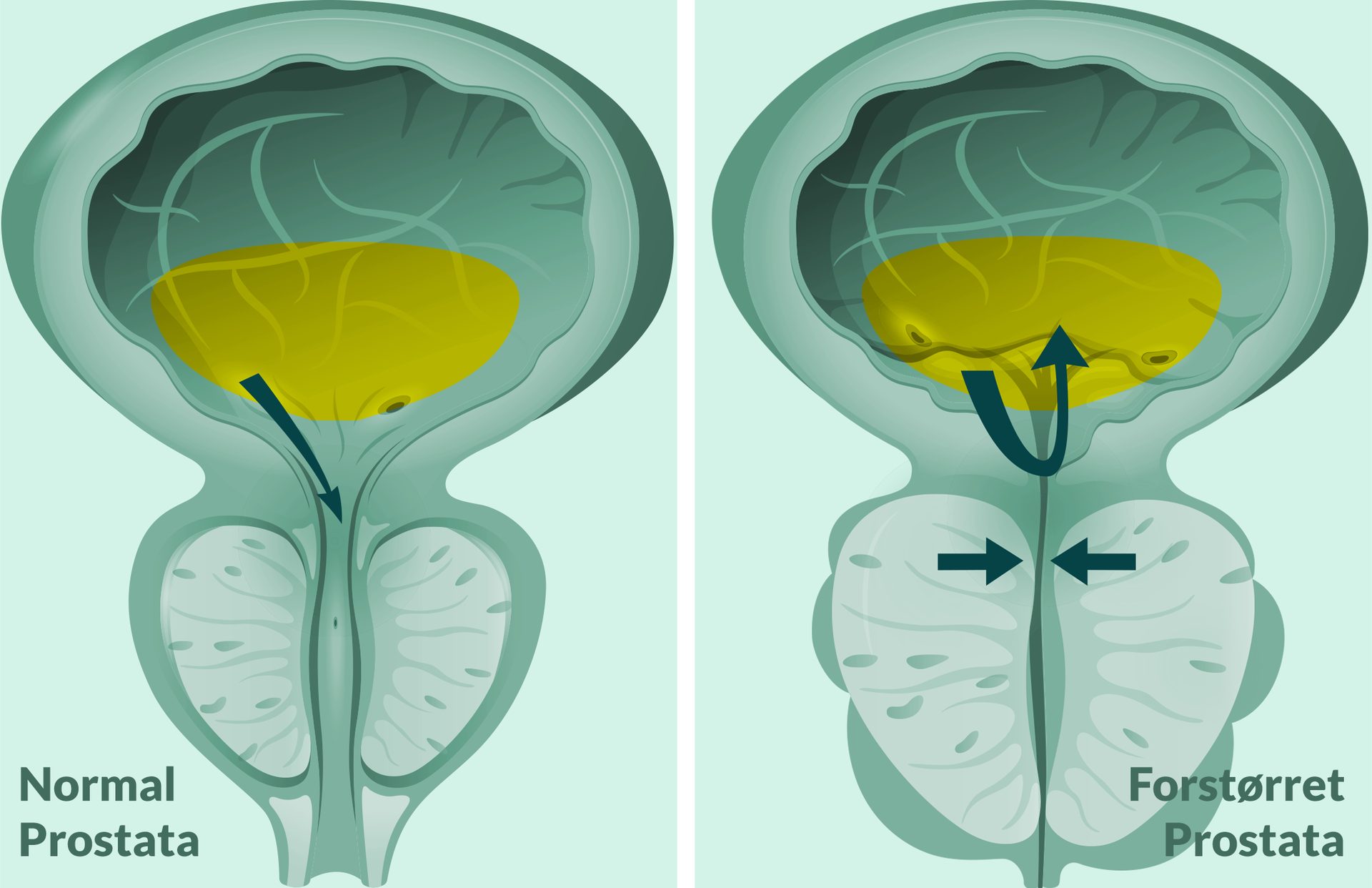 Diagram of normal prostate allowing urine flow, vs. enlarged prostate blocking it.