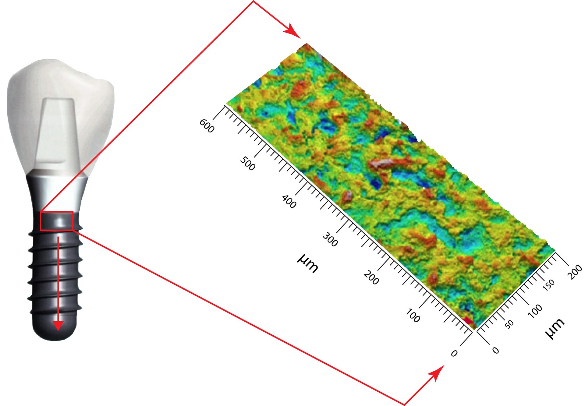 Dental implant with a colorful, magnified topographic map of its surface roughness, scaled in µm.