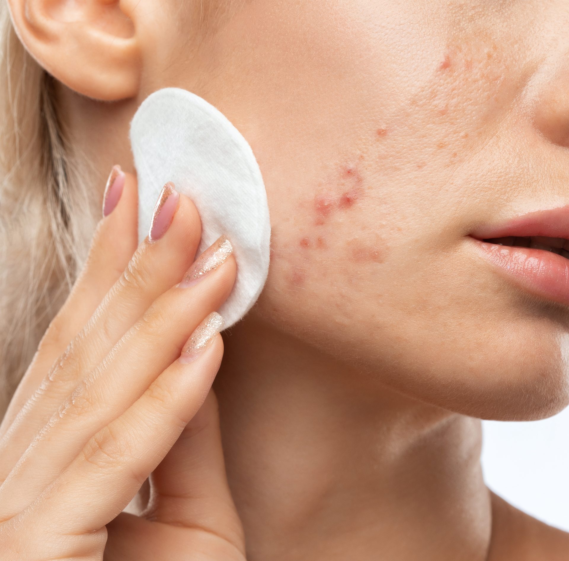 Hand with manicured nails applying a cotton pad to an acne-prone cheek.