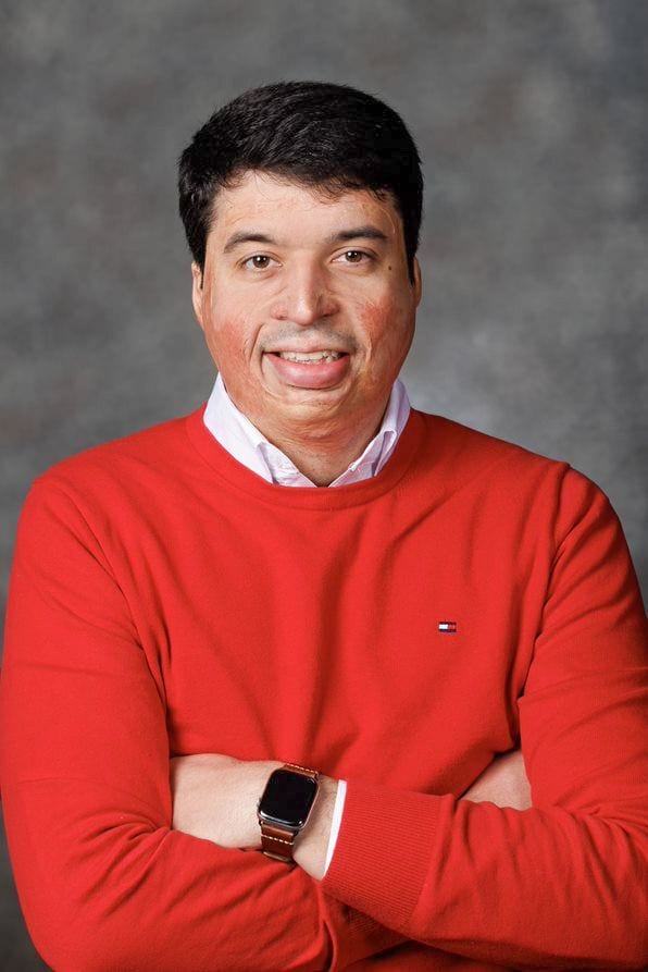 Man in red sweater smiles at camera, showing facial scarring and wearing a smartwatch.