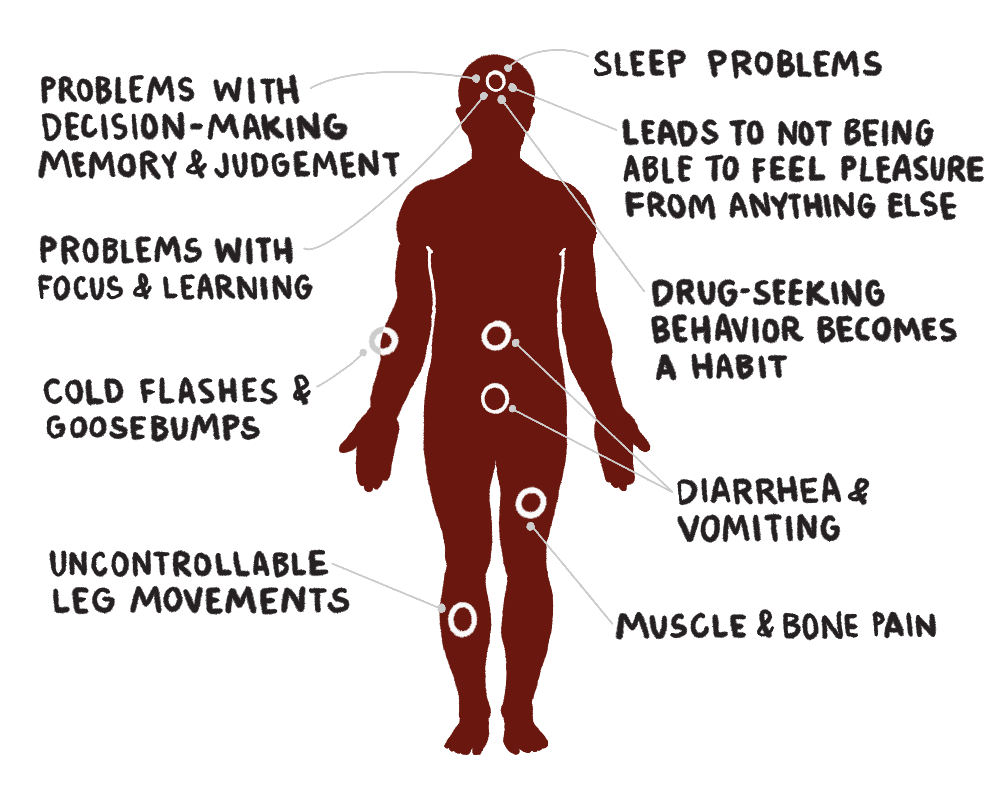 Diagram showing  how opioids impact the human body with call outs: problems with decision-making memory and judgement, problems with focus and learning, cold flashes and goosebumps, uncontrollable leg movements, sleep problems, leads to not being able to feel pleasure from anything else, drug-seeking behavior becomes a habit, diarrhea and vomiting, and muscle and bone pain 