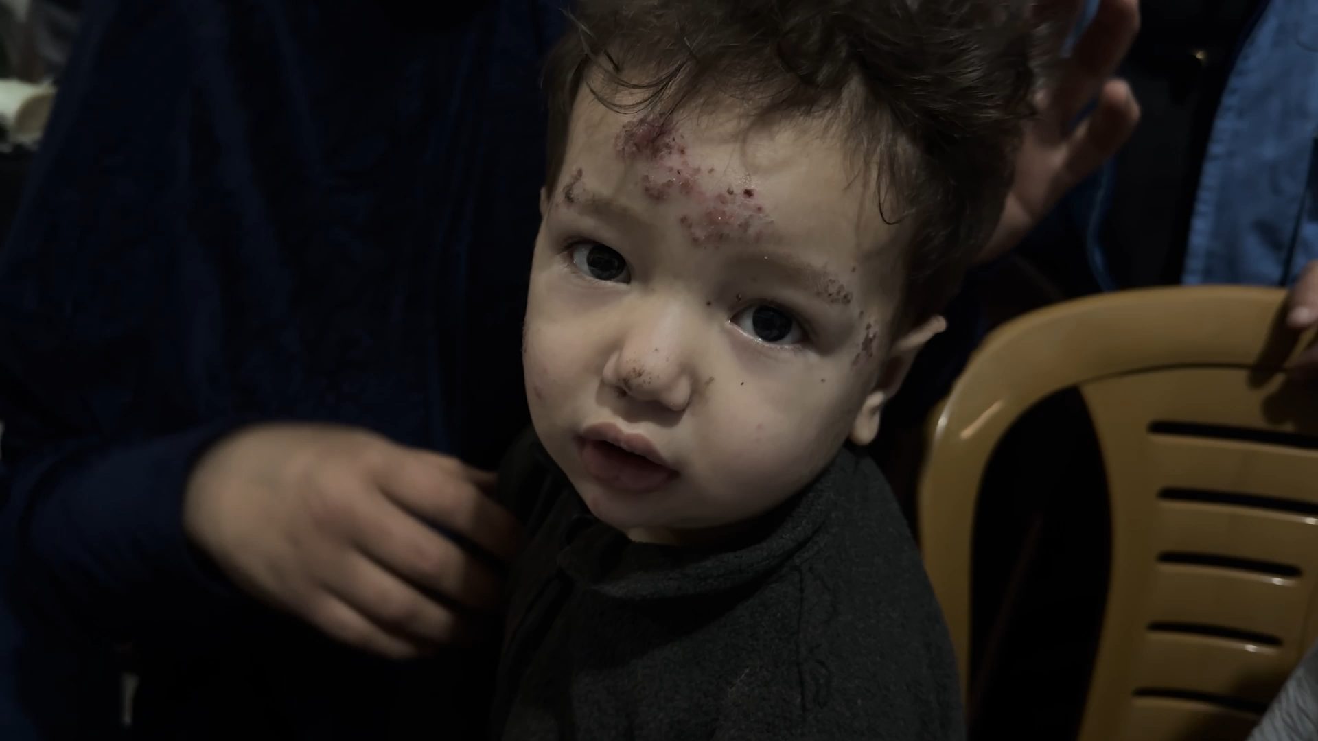 Close-up of a baby with skin marks on their forehead and nose, looking directly at the camera.
