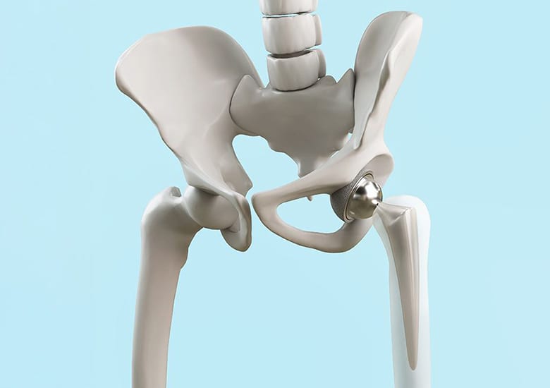 Hip replacement